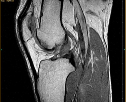Sagittal MRI of a knee showing femur, tibia, and surrounding soft tissues with the joint space visible.