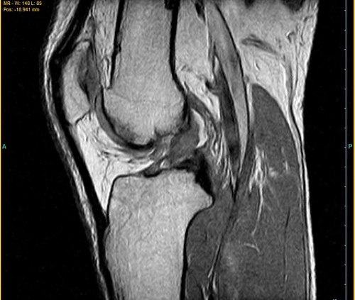 Sagittal MRI of a knee showing femur, tibia, and surrounding soft tissues with the joint space visible.