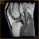 Sagittal MRI of a knee showing femur, tibia, and surrounding soft tissues with the joint space visible.